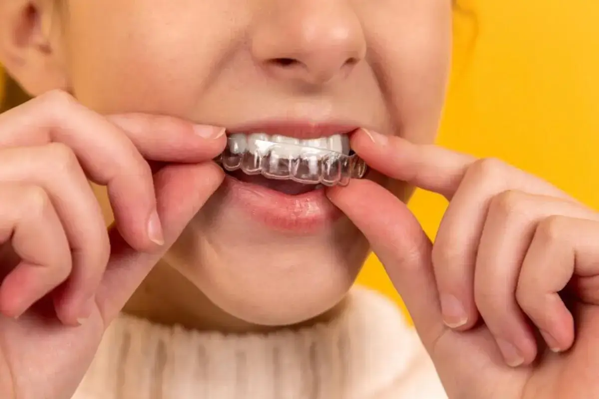 Dita che cercano di inserire un apparecchio di contenzione trasparente sui denti, ma sembra che non entra.
