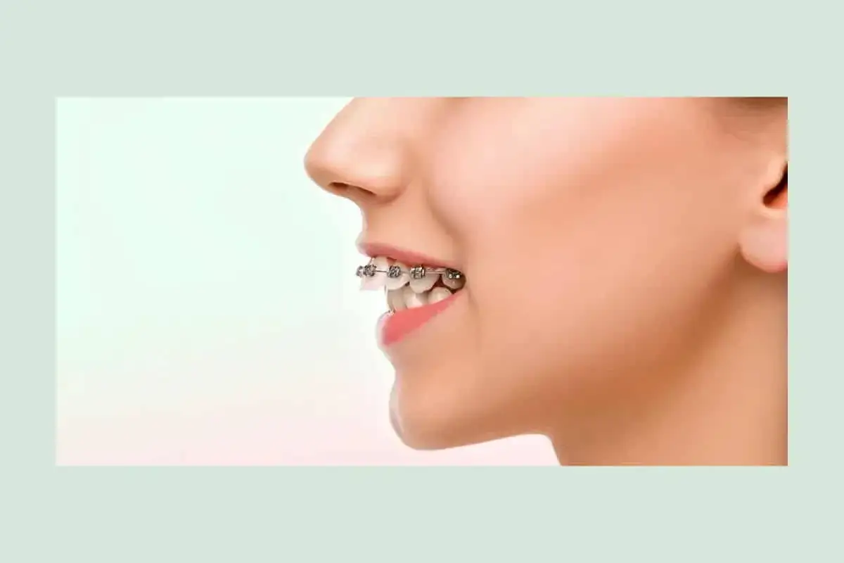 Profilo di una persona con apparecchio ortodontico che corregge i denti sporgenti.