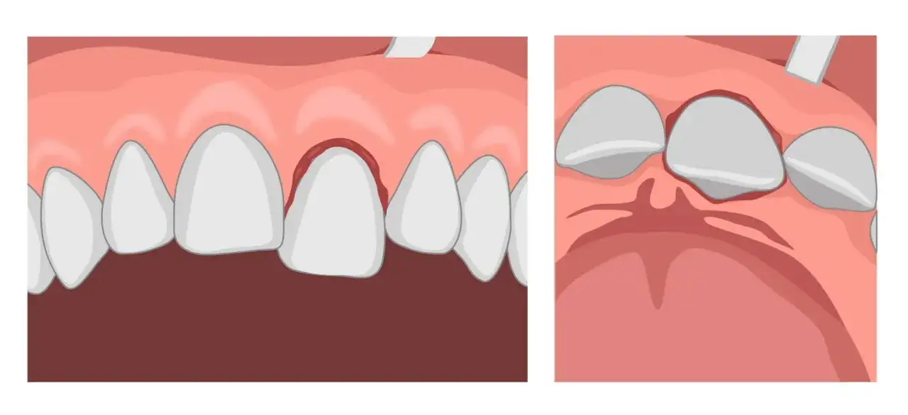 Illustrazione di gengive infiammate e retratte, con denti staccati che mostrano la radice.