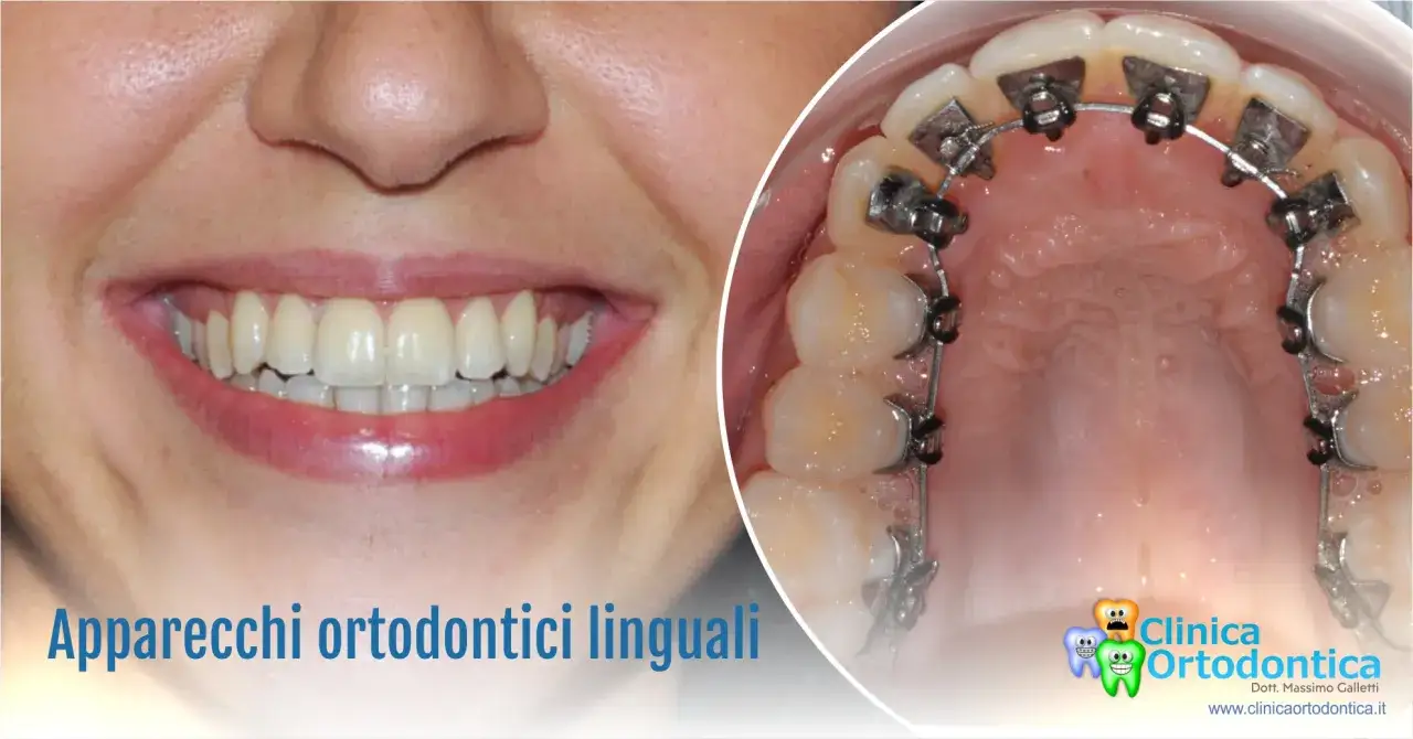 Sorriso smagliante con apparecchio invisibile per adulti. Ortodonzia linguale per un sorriso perfetto e discreto.