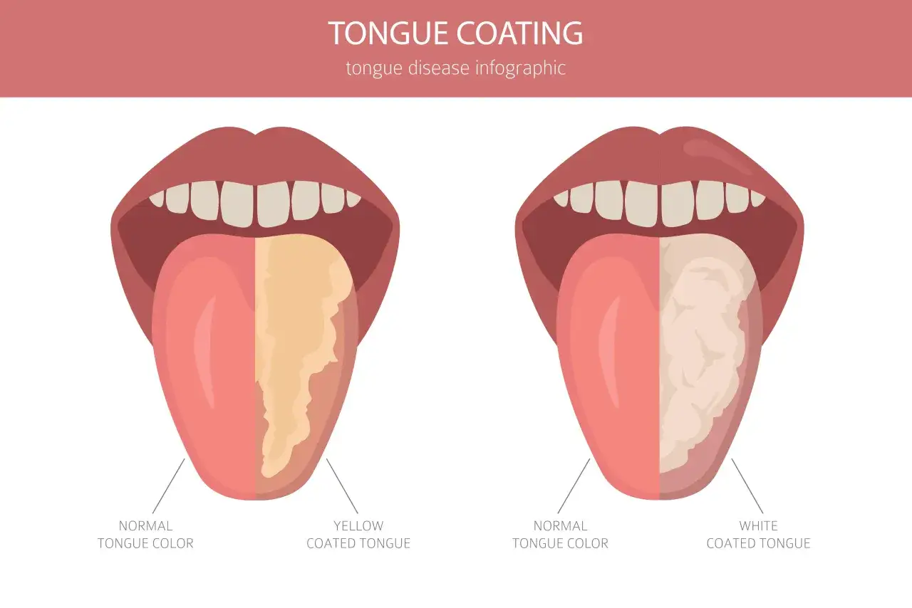 Lingua normale a sinistra, lingua gialla e bianca a destra. Infografica sulle malattie della lingua.