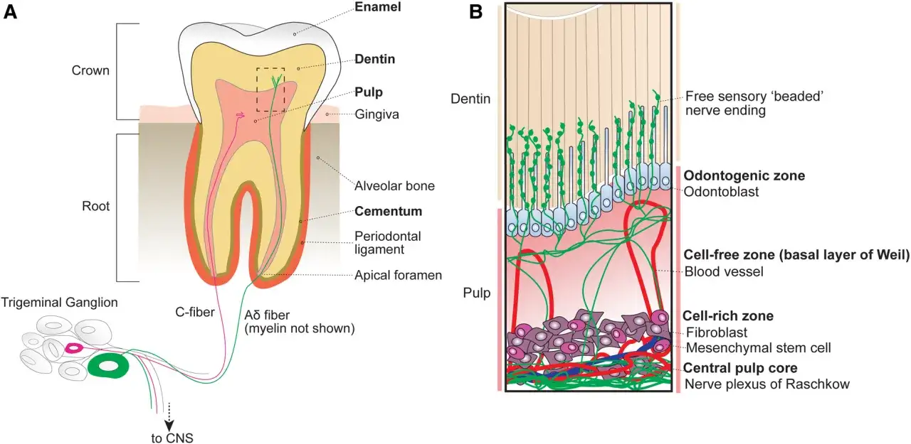 Sezione trasversale di un dente che illustra la polpa dentale e le fibre nervose. La pulpite dente &egrave; un'infiammazione dolorosa.
