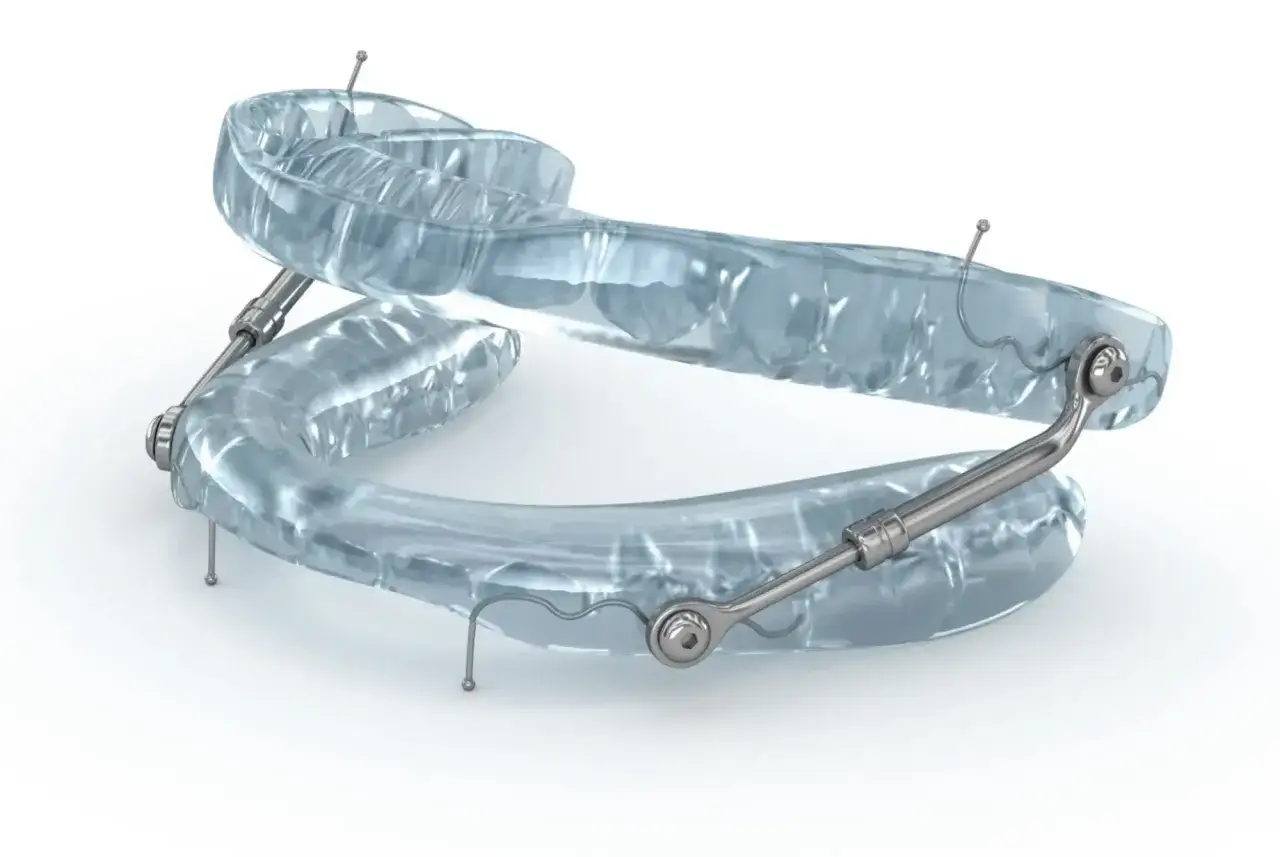 Dispositivo trasparente per contrastare le apnee notturne, con elementi metallici che collegano le due arcate dentali.