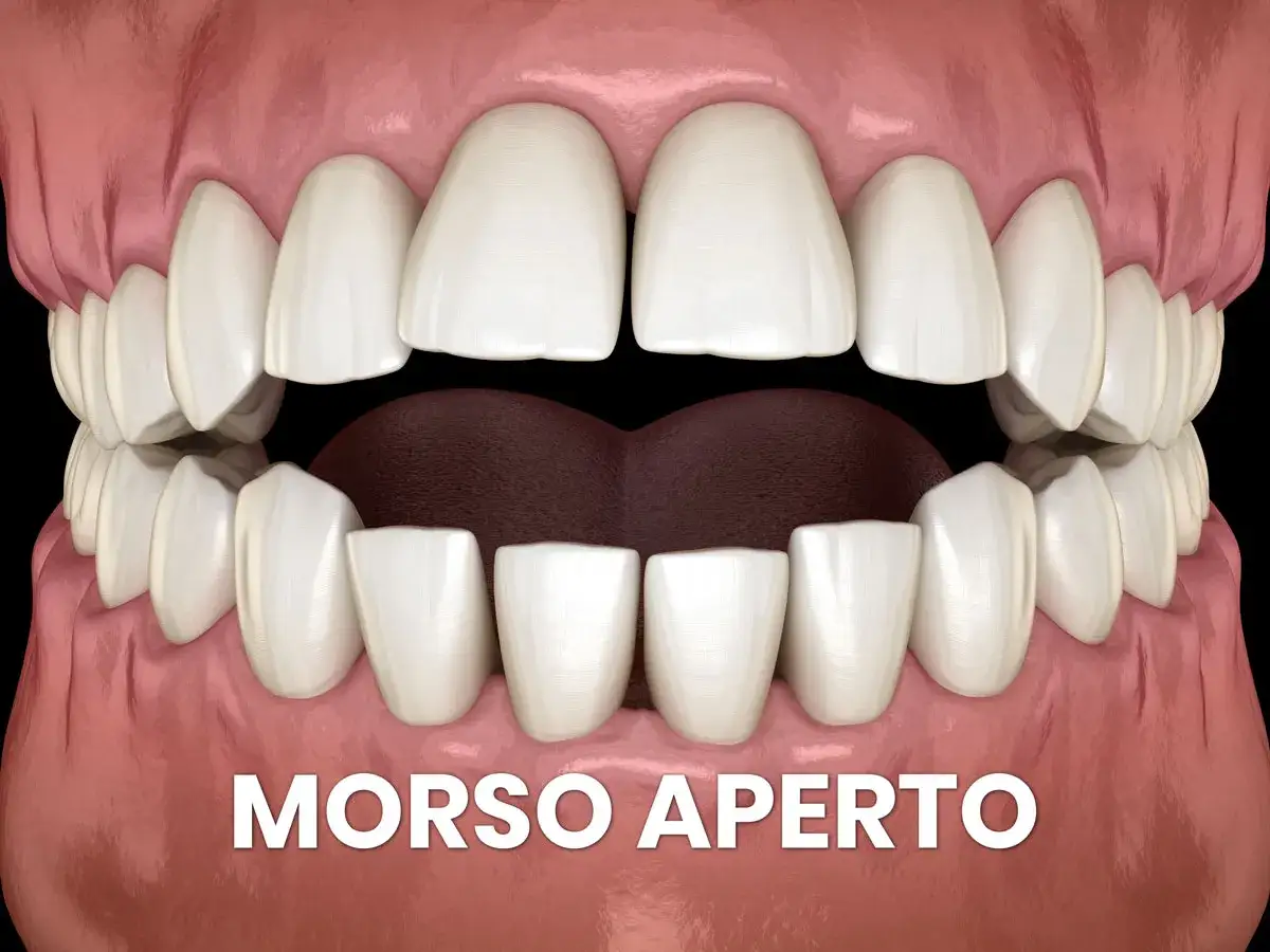 Denti bianchi e gengive rosa in un primo piano che mostra un morso aperto, con la scritta 