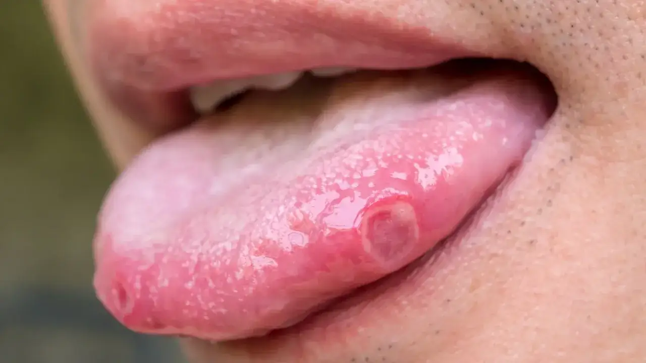 Lingua con lesioni, forse herpes lingua, che causano dolore e disagio.