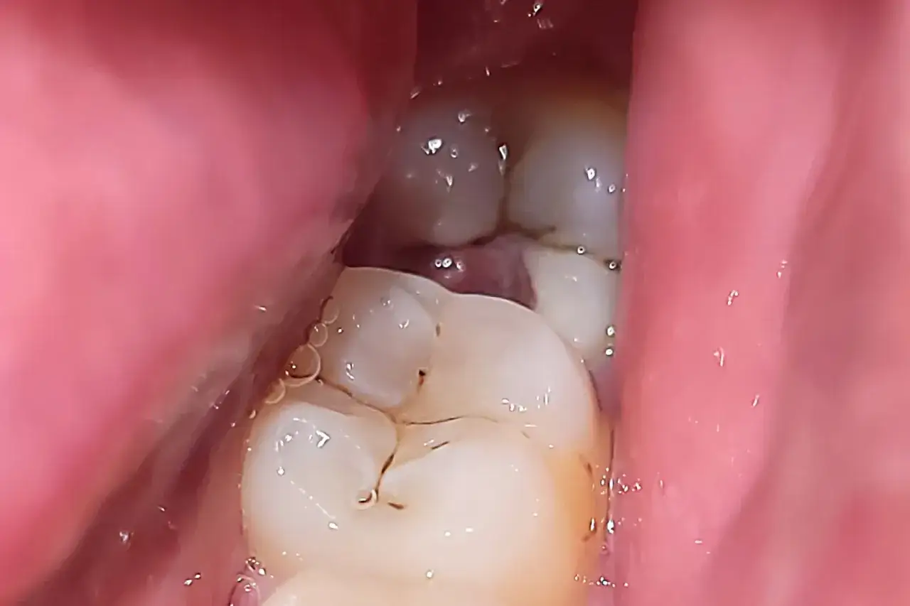 Gengive arrossate e gonfie intorno ai denti, possibili segni di stomatite. Piccole bollicine d'acqua visibili.
