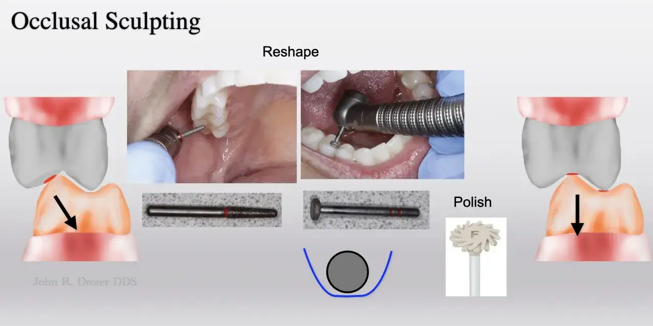Modellazione occlusale: il significato dell'ortodonzia è scolpire i denti per un morso perfetto, con strumenti per rimodellare e lucidare.