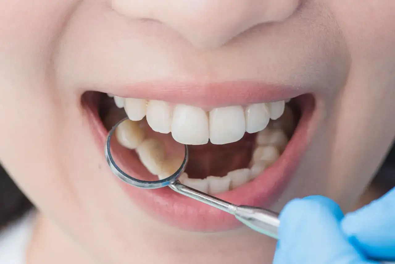 Bocca aperta con denti bianchi e un piccolo specchietto dentale che riflette i molari, evidenziando un leggero affollamento dentale.