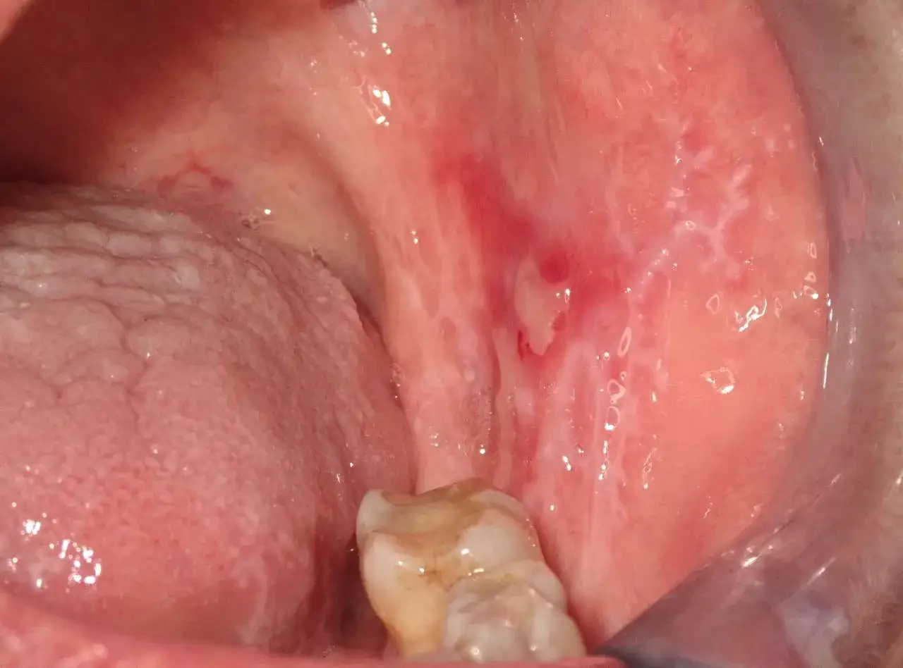 Bocca con lesioni biancastre e arrossate, indicative di stomatite virale. Si notano anche la lingua e un dente.
