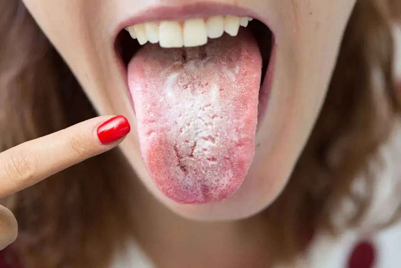 Lingua con patina bianca, sintomo di candida orale. Scopri i rimedi naturali e le cure efficaci per combatterla.