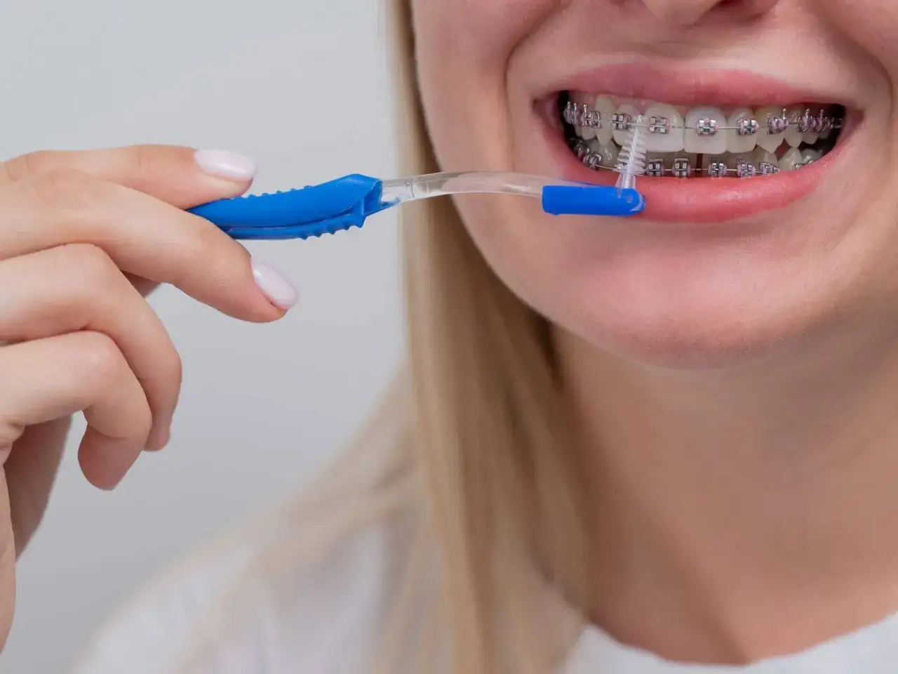 Ragazza pulisce apparecchio ortodontico con spazzolino interdentale. Nessun mal di denti apparecchio, solo igiene perfetta.