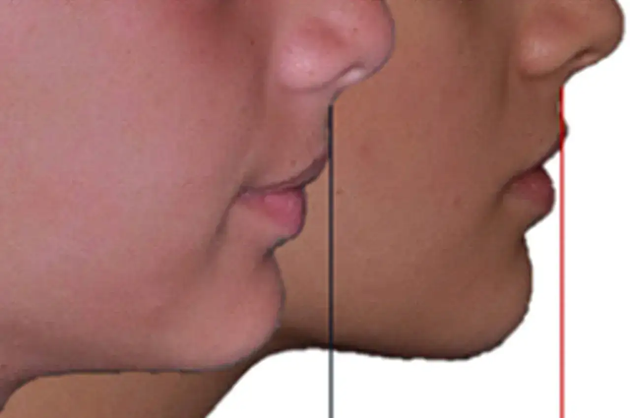 Confronto profili: un morso profondo sul viso evidenziato da linee guida verticali.