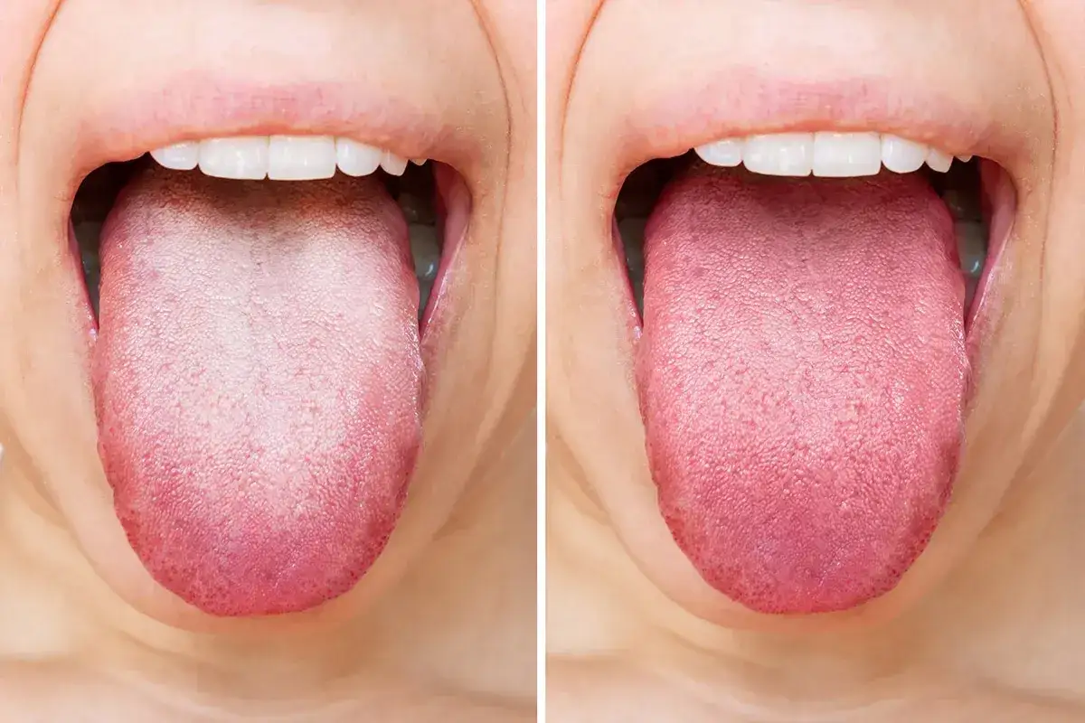 Lingua impaniata prima e dopo il trattamento. La lingua bianca e opaca diventa rosa e sana.