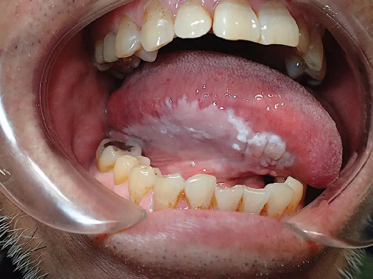 Lingua con aree biancastre, suggestive di leucoplachia, una condizione che può evolvere in tumore alla lingua.