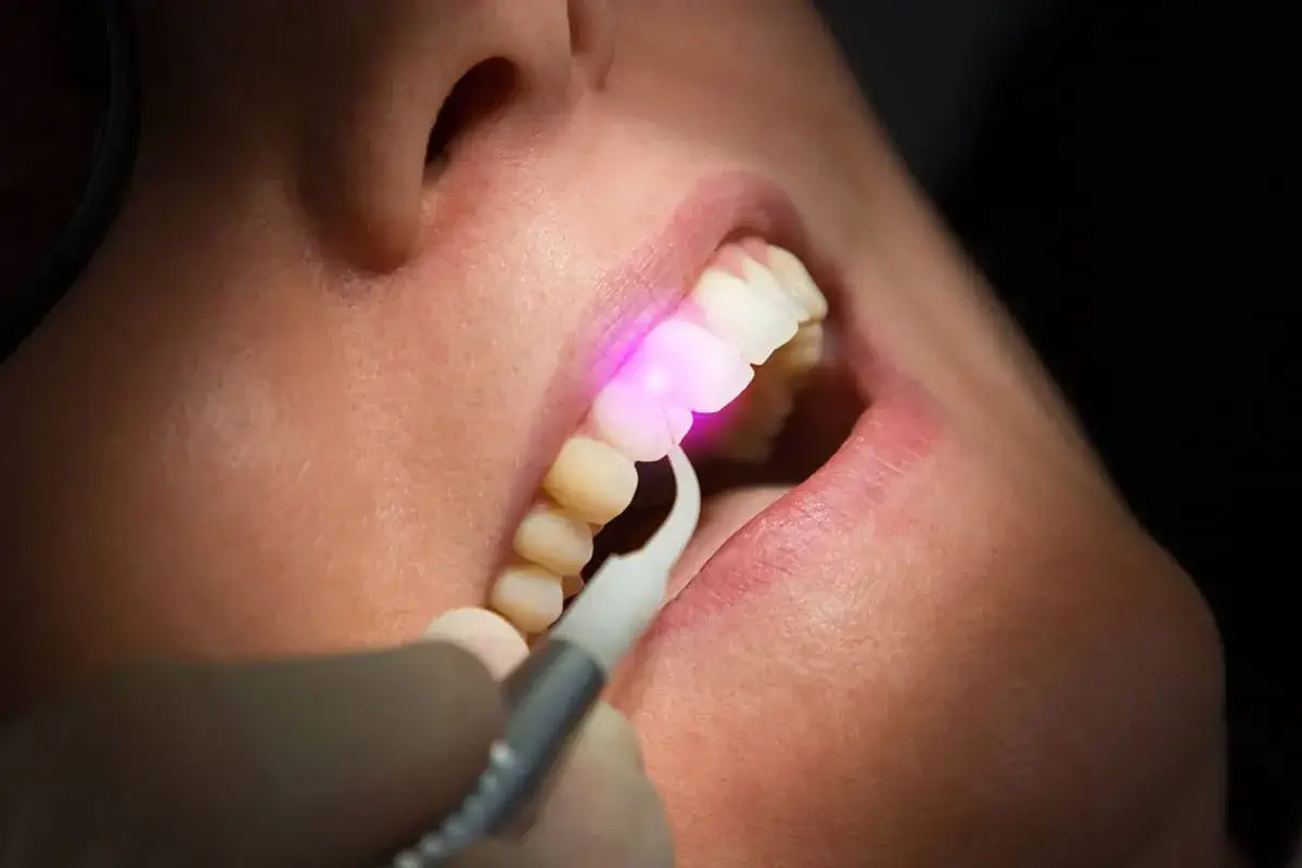 Trattamento dentale con laser: un raggio rosa illumina un dente per una cura precisa e moderna.