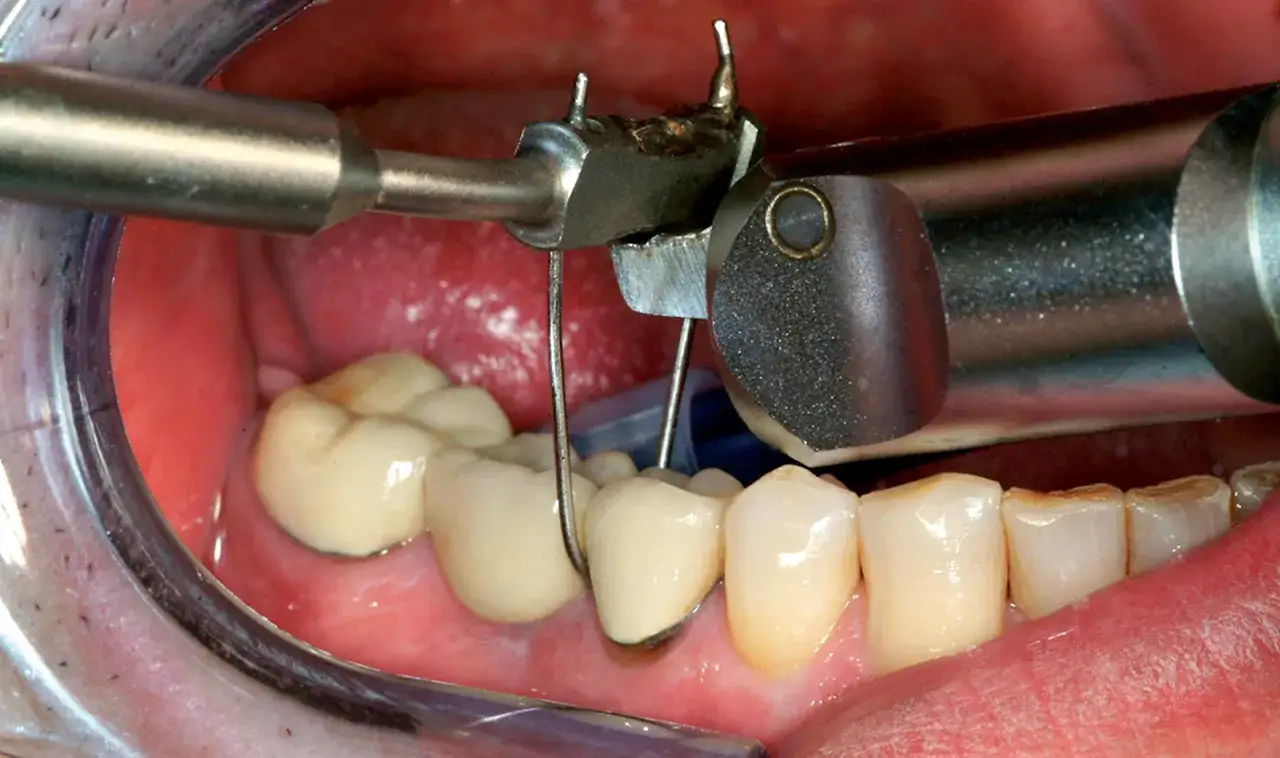 Strumento dentale in azione per la medicazione di un dente devitalizzato.