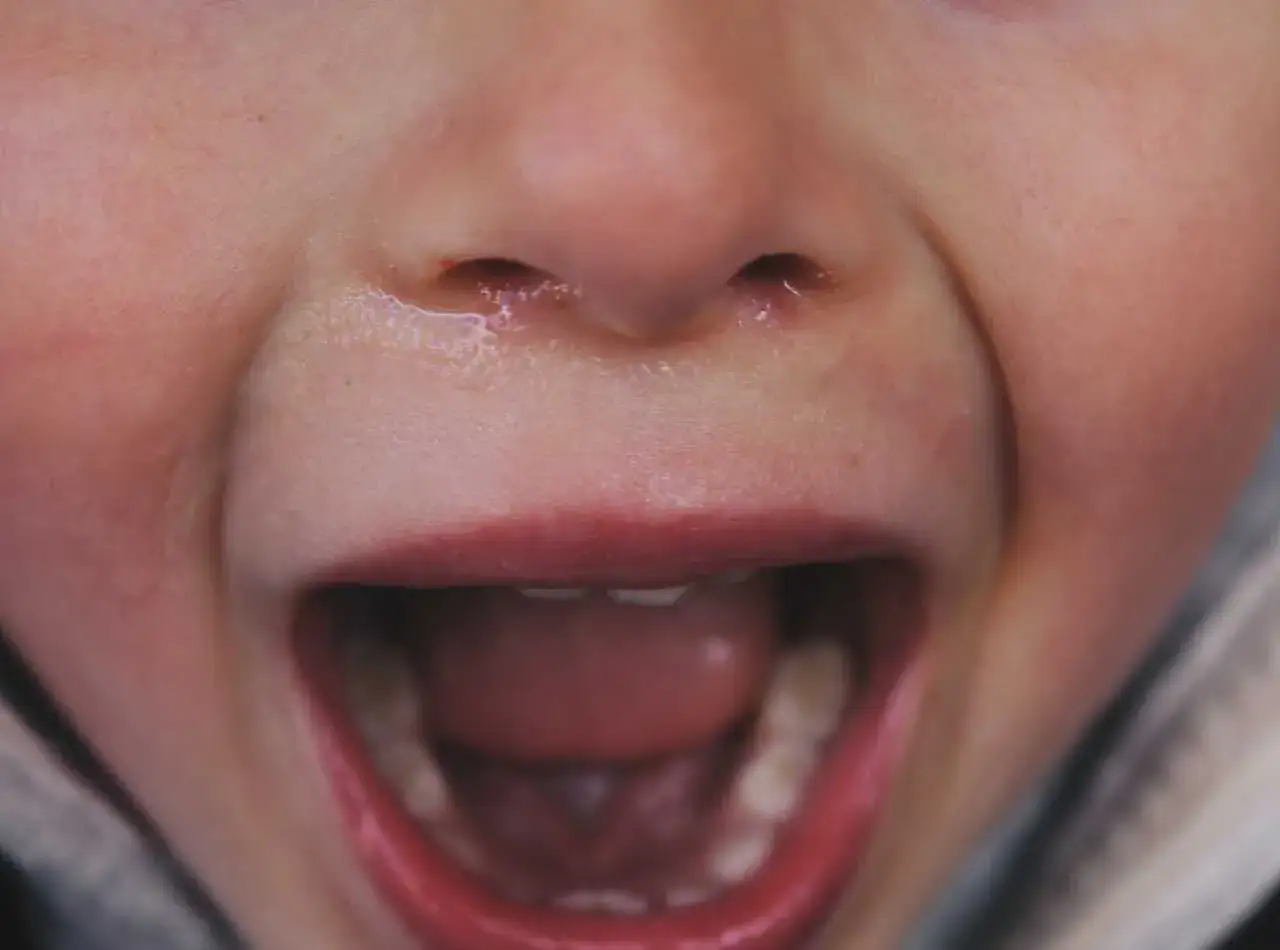 Bocca aperta di un bambino con denti storti da ciuccio, naso umido e labbra rosse.