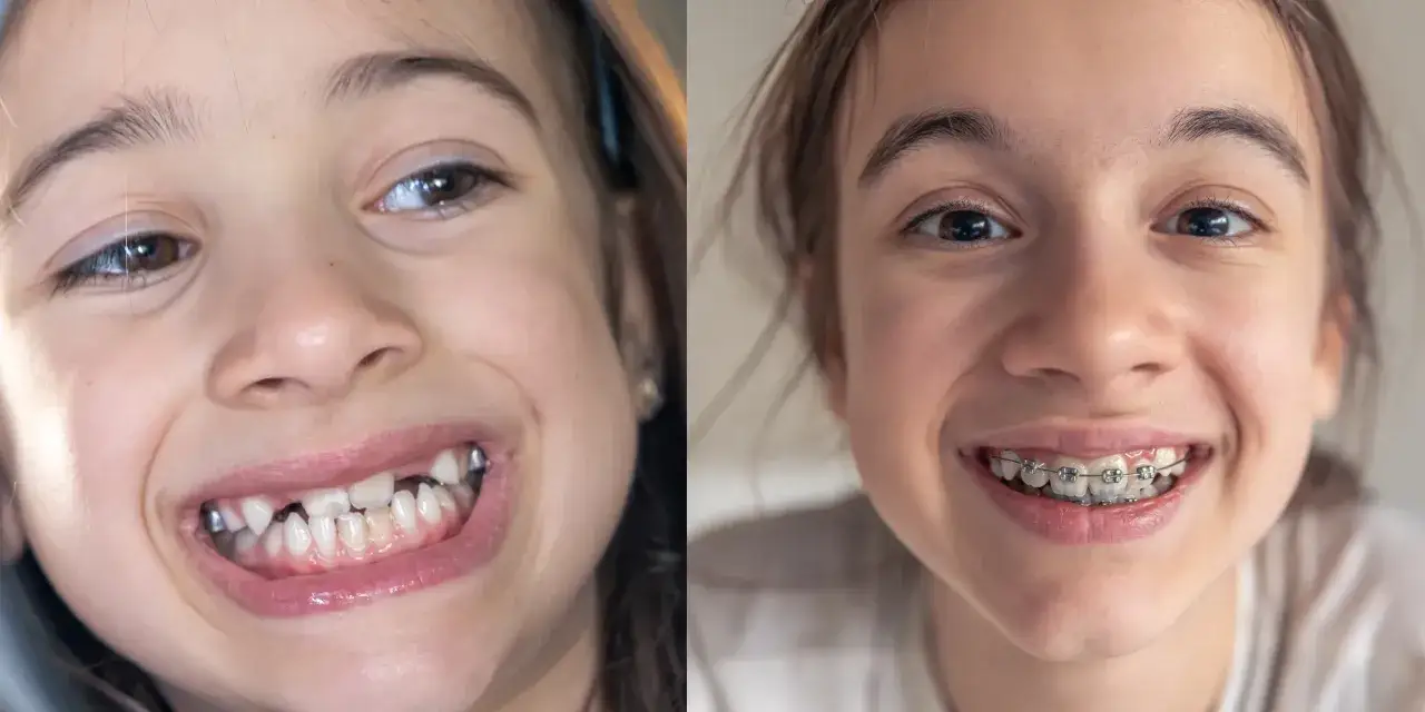 Denti sporgenti prima e dopo: un sorriso trasformato con l'apparecchio.