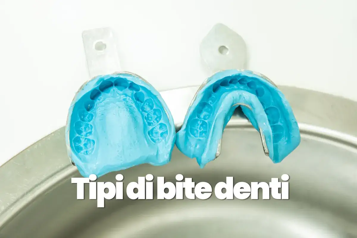 Modelli blu di impronte dentali, utili per creare un bite dentale per rilassare la muscolatura.
