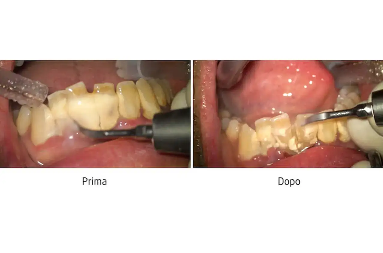Prima e dopo la rimozione del tartaro denti. Si vede un accumulo di tartaro sui denti prima del trattamento e denti puliti dopo.