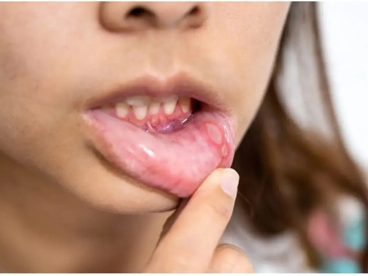 Labbra con piaghe da apparecchio ortodontico, dolorose ulcere che rendono difficile parlare e mangiare.