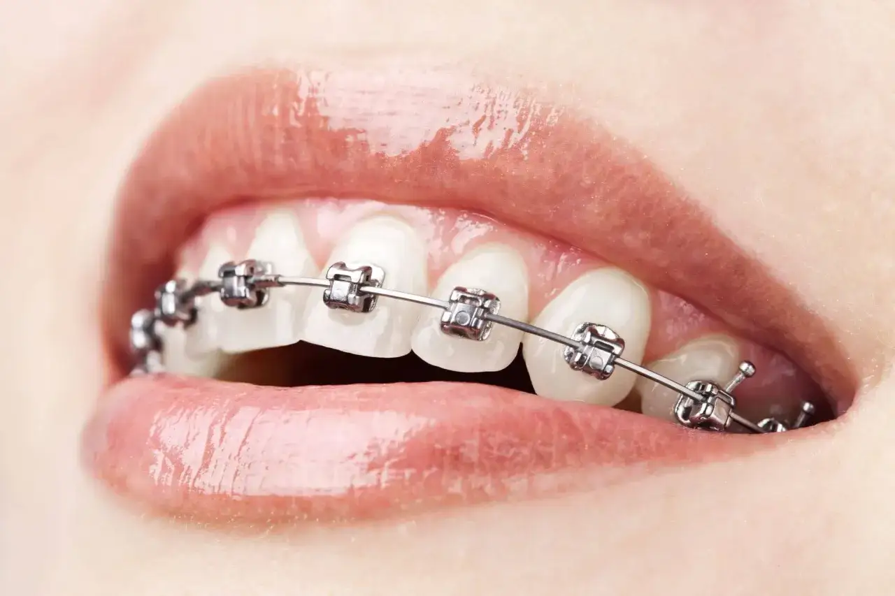 Denti con apparecchio ortodontico. Scopri il filo contenzione denti costo per un sorriso perfetto.