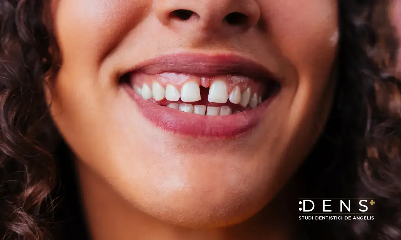 Sorriso con diastema. Scopri come chiudere lo spazio tra i denti fai da te, ma consulta sempre un dentista per soluzioni sicure.