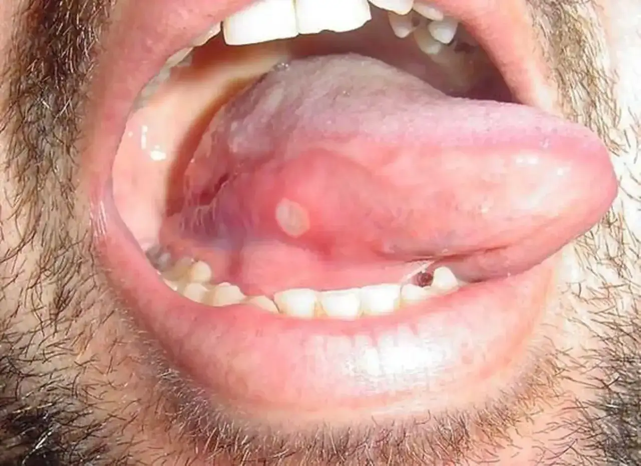 Lingua con lesioni orali evidenti, una delle quali è una vescicola bianca circondata da rossore. Denti e labbra visibili.