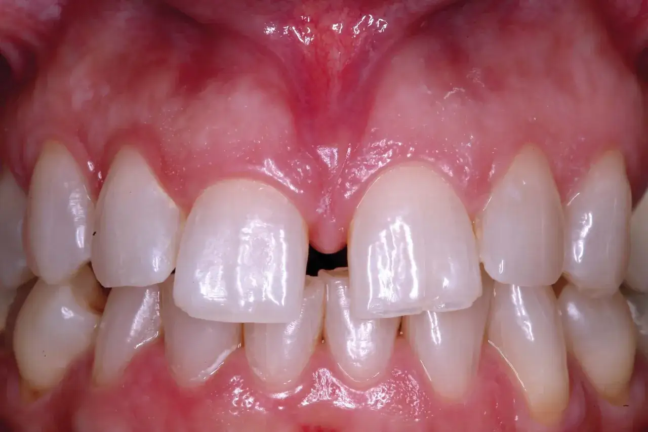 Denti anteriori con diastema centrale, gengive rosa e un frenulo labiale superiore visibile.