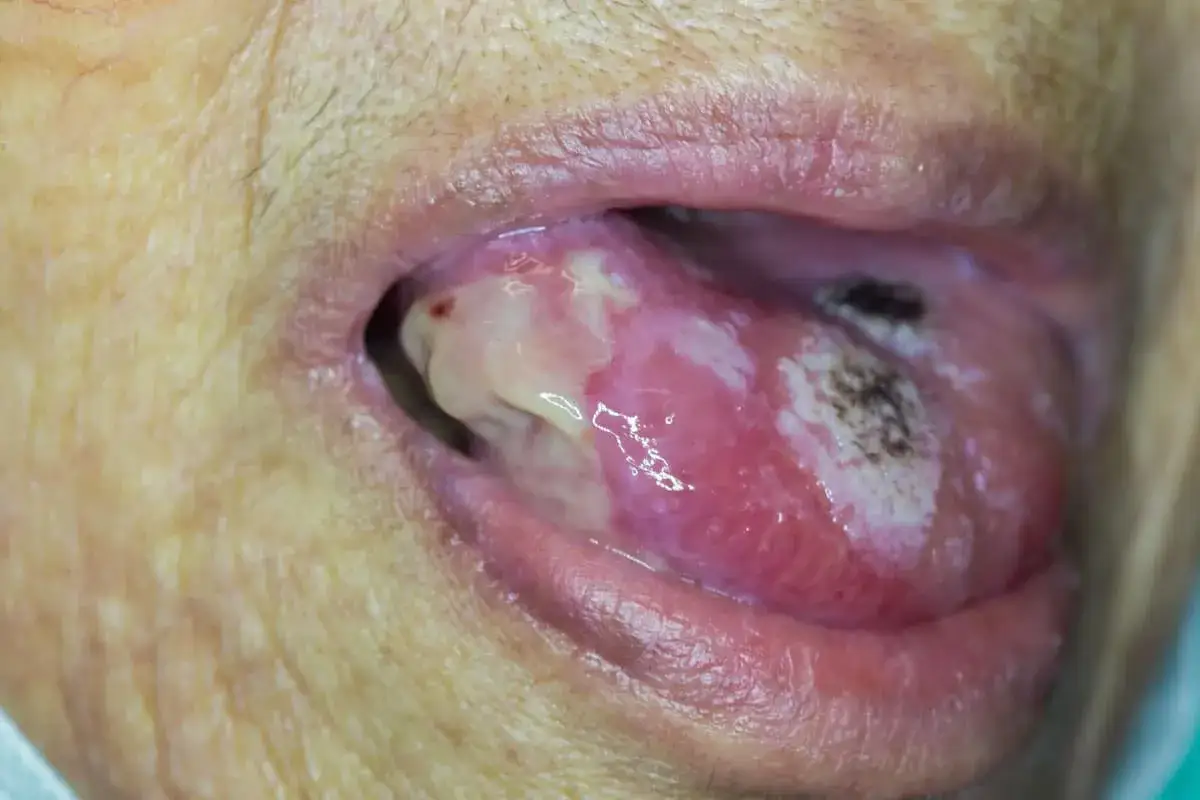 Lingua con lesioni biancastre e aree necrotiche, indicative di carcinoma squamoso lingua.