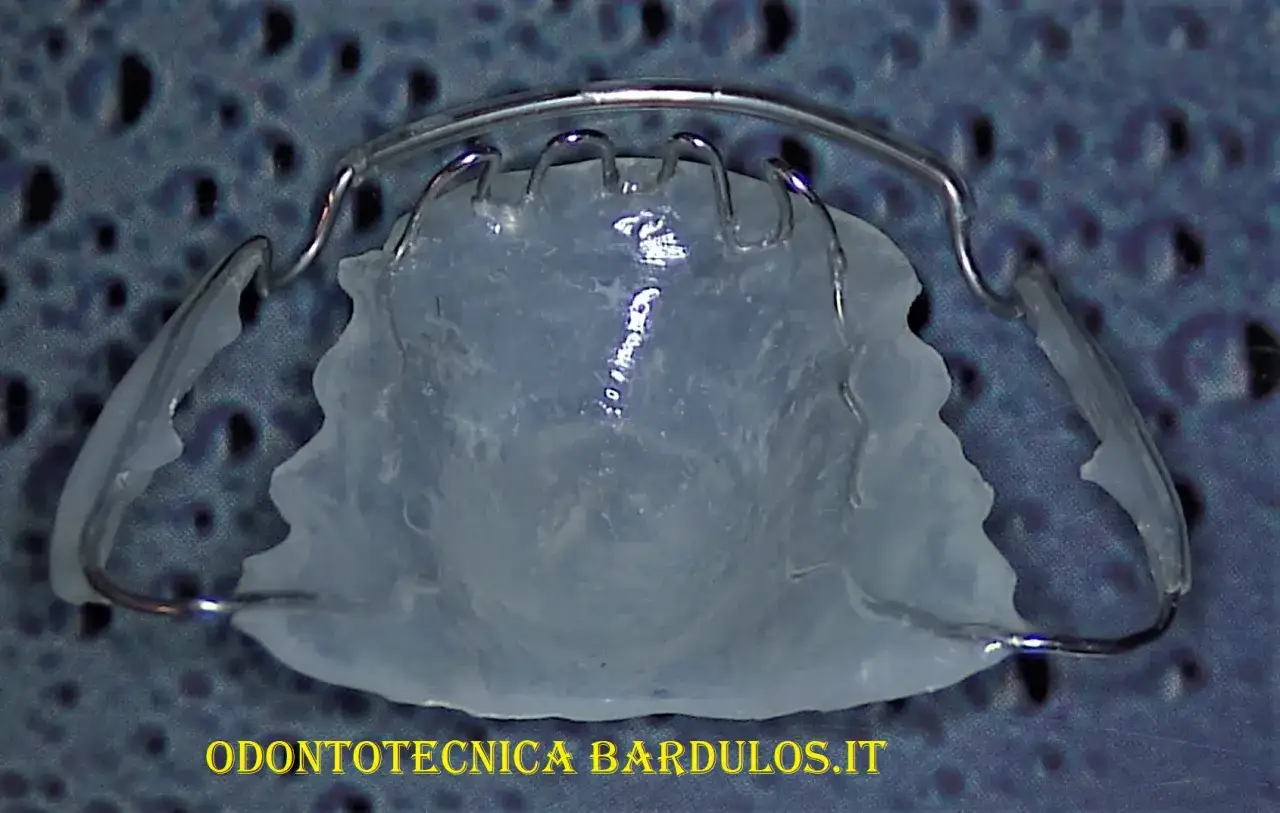 Un elevatore linguale notturno personalizzato, con filo metallico e base in resina trasparente, pronto per correggere la posizione dei denti durante il sonno.