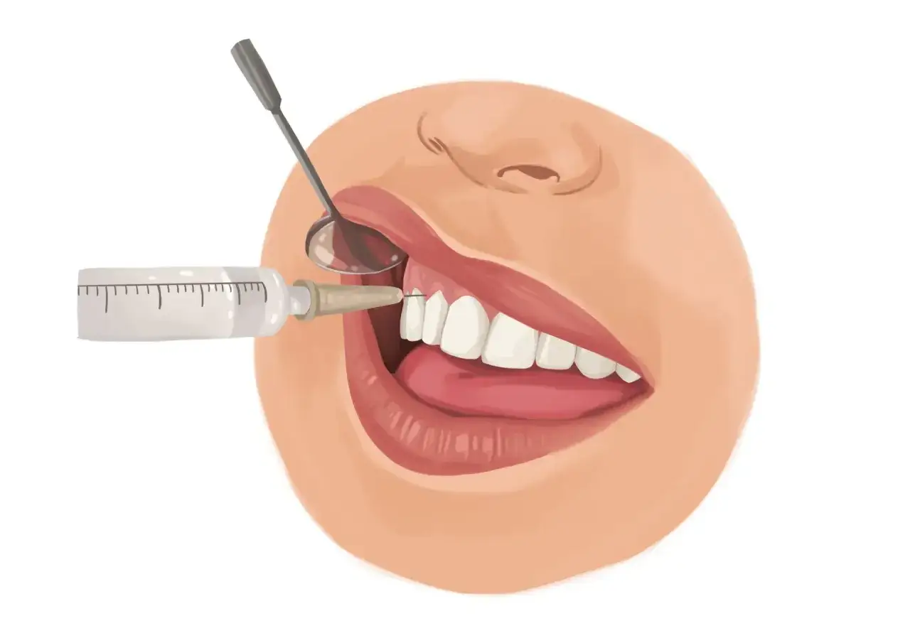 Un dentista effettua la pulizia dei denti con anestesia, usando una siringa e uno specchietto.