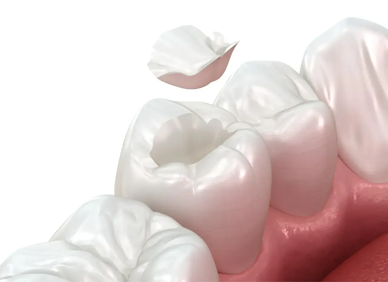 Preparazione intarsio dentale: un dente con una cavit&agrave; pronta per ricevere un restauro su misura, mentre un frammento bianco fluttua sopra.