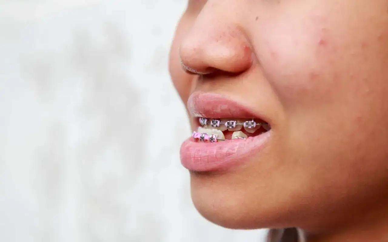 Primo piano di un sorriso con apparecchio per morso incrociato, con brackets rosa e metallici che correggono l'allineamento dei denti.