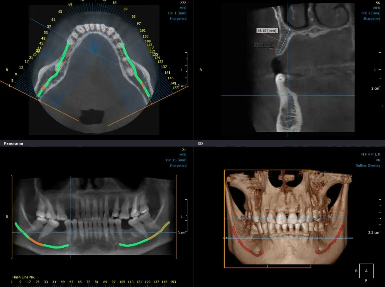 Immagine TAC dentale che mostra il canale naso palatino, con misurazioni e sezioni trasversali.