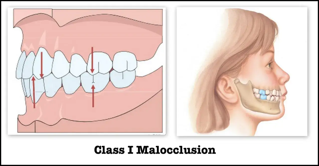Illustrazione di malocclusione di Classe I, con frecce che indicano l'allineamento dei denti. Il significato di ATM è legato alla salute dentale.
