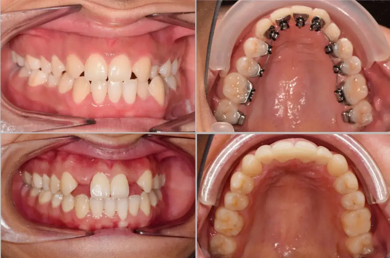Denti con agenesia dentale, prima e dopo apparecchio. Valutare i costi per risolvere il problema.