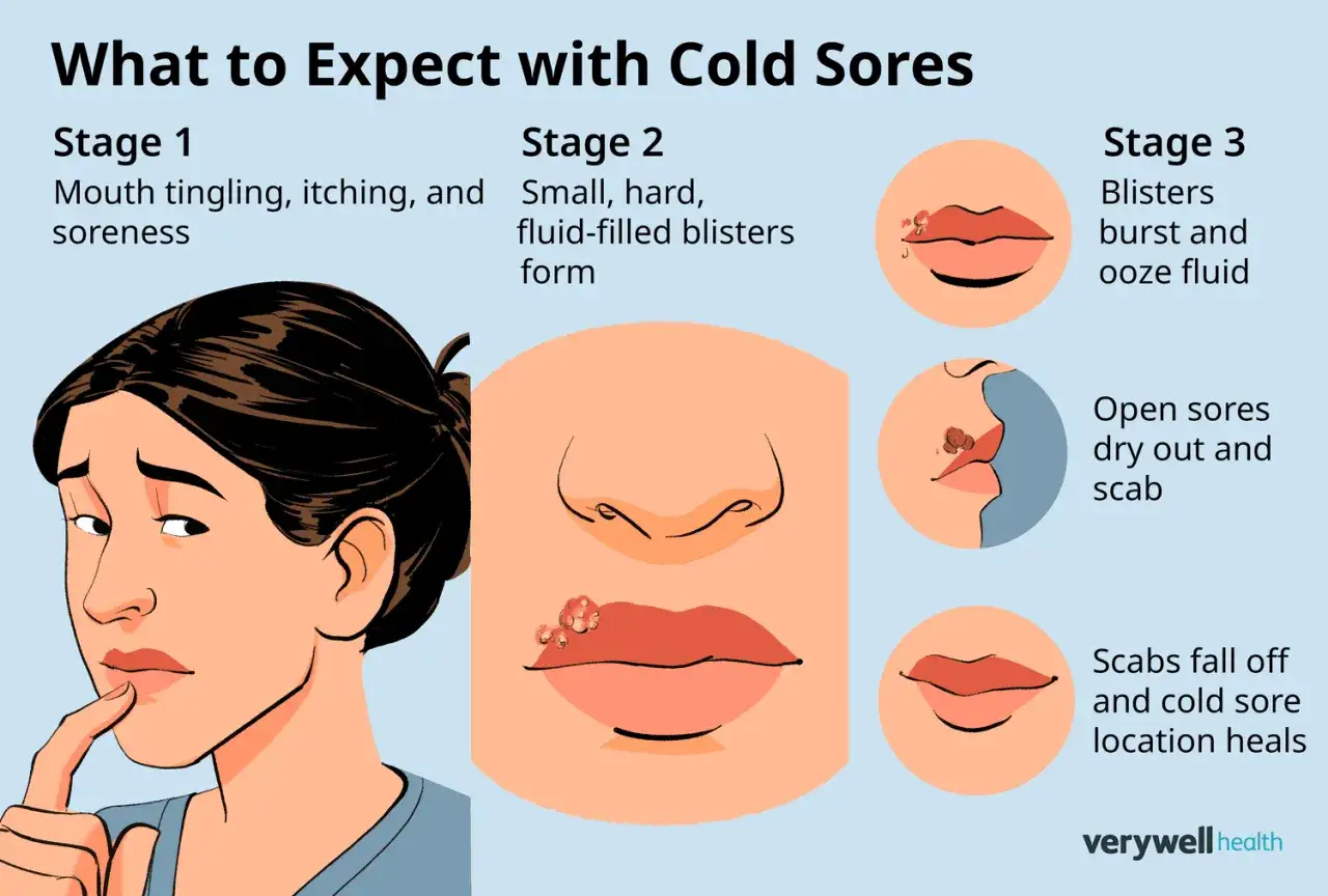 Illustrazione delle fasi del herpes labiale: formicolio, vescicole, ulcere e guarigione. Scopri quanto dura il herpes labiale.