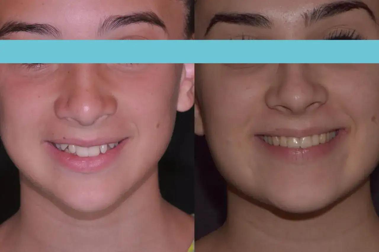 Prima e dopo: correzione di un morso profondo con apparecchio. Sorrisi più armoniosi e funzionali.