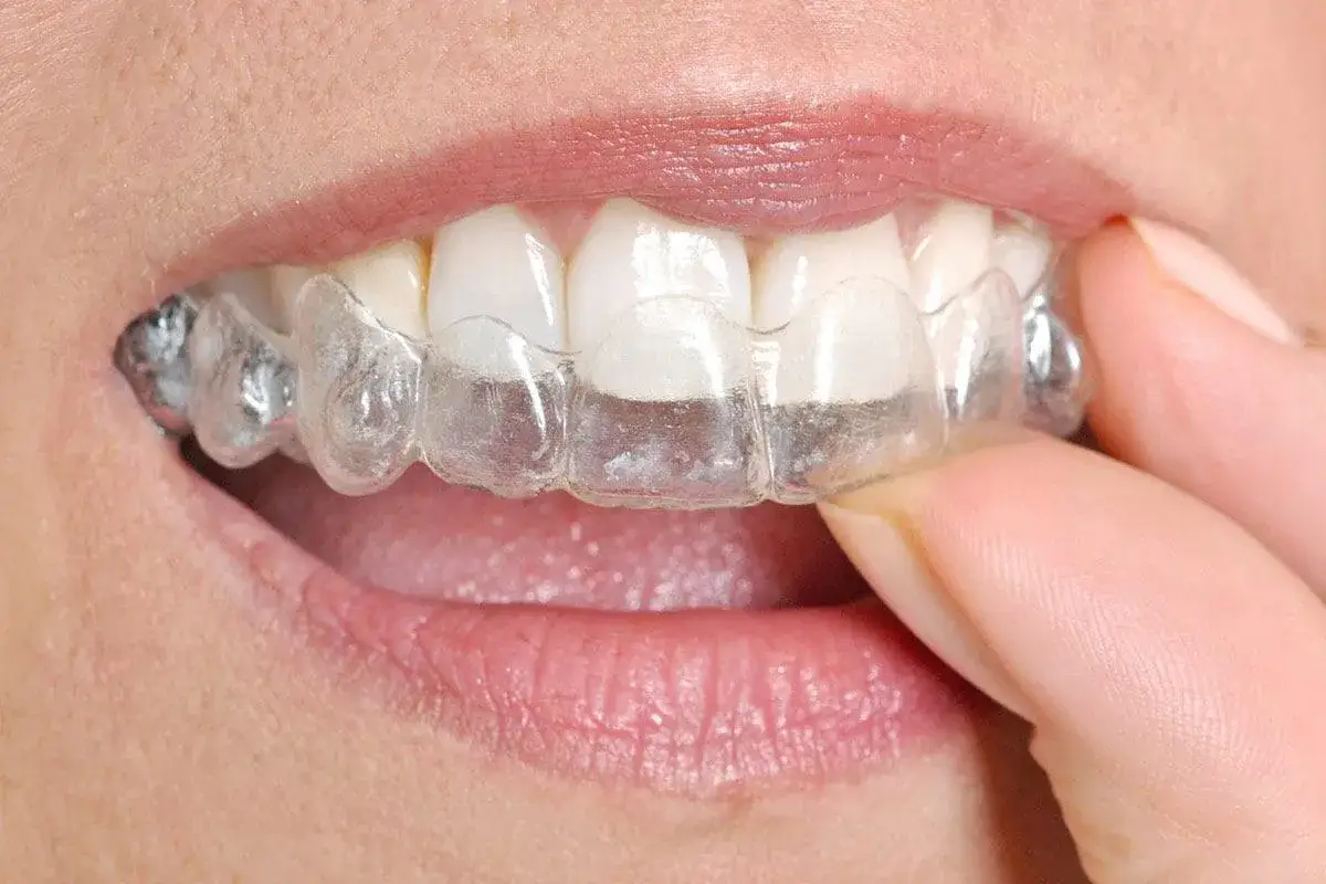 Denti inferiori con apparecchio trasparente per correggere l'affollamento dentale inferiore.