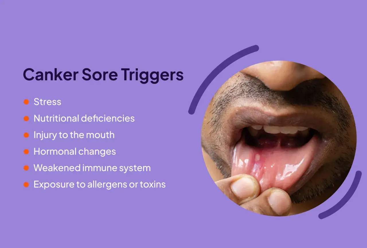 Stomatite bocca: cause come stress, carenze nutrizionali, traumi, ormoni, sistema immunitario debole o allergeni.