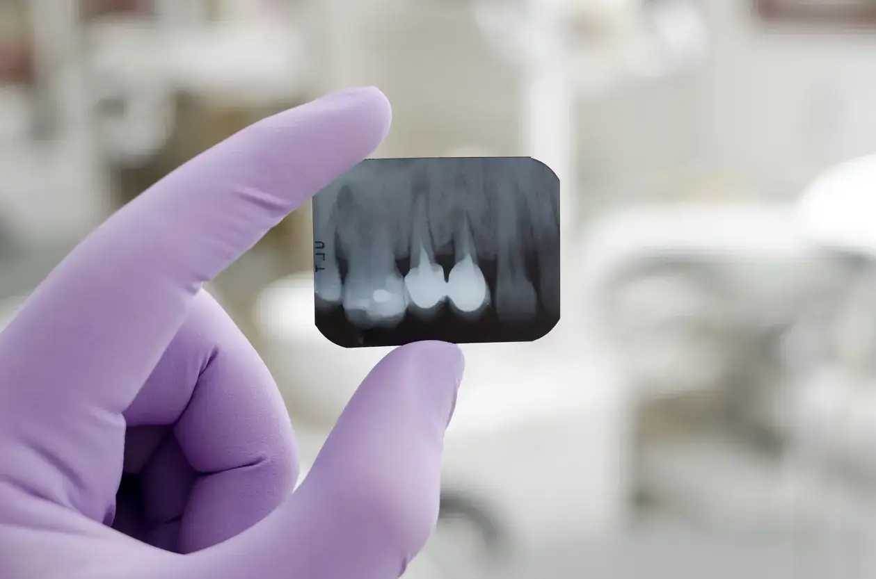 Mano con guanto viola tiene radiografia dentale. Si vedono denti con otturazioni e possibili crepe sui denti.
