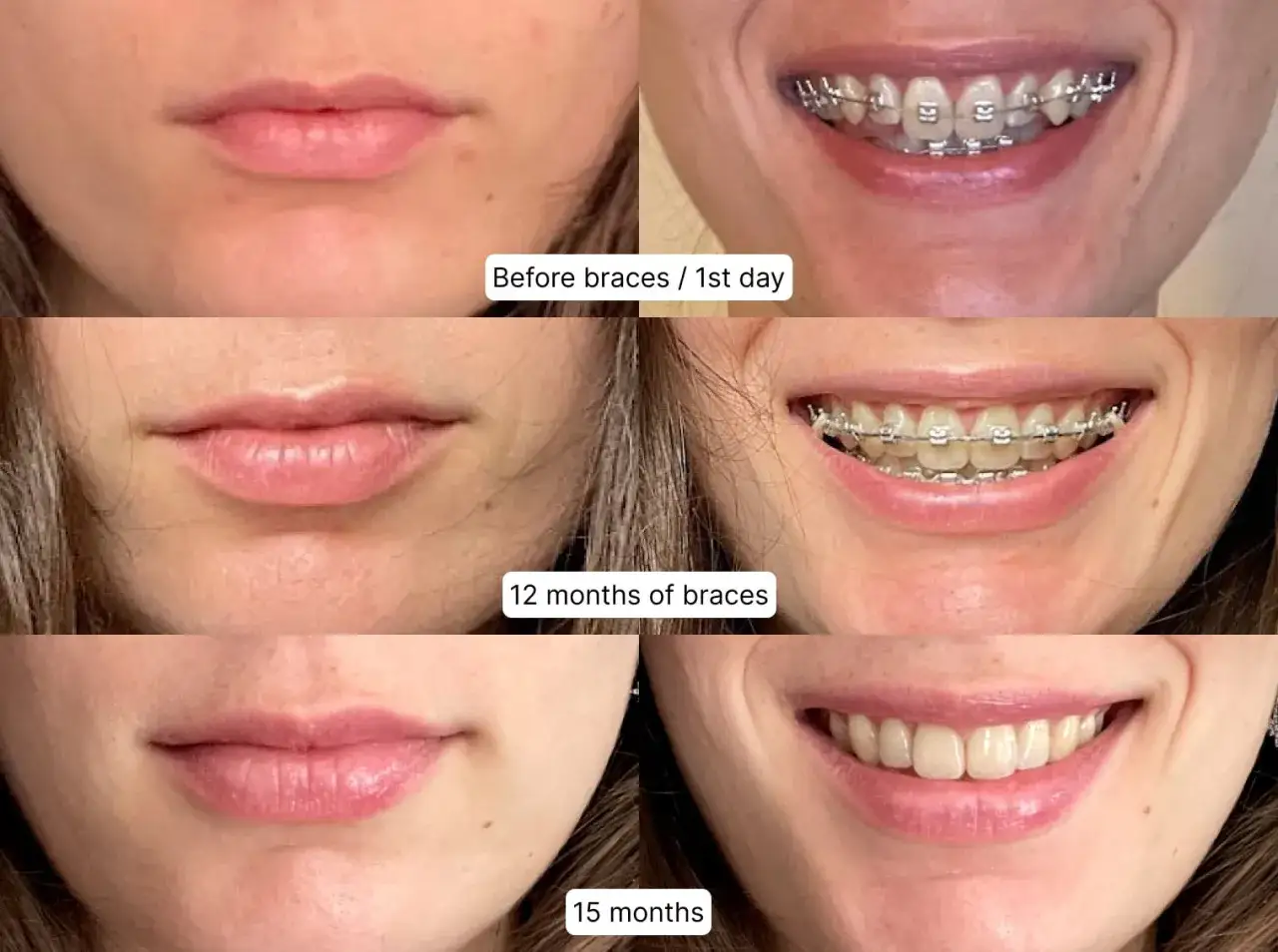 Confronto labbra prima e dopo apparecchio: sorriso più armonioso dopo 15 mesi di trattamento ortodontico.