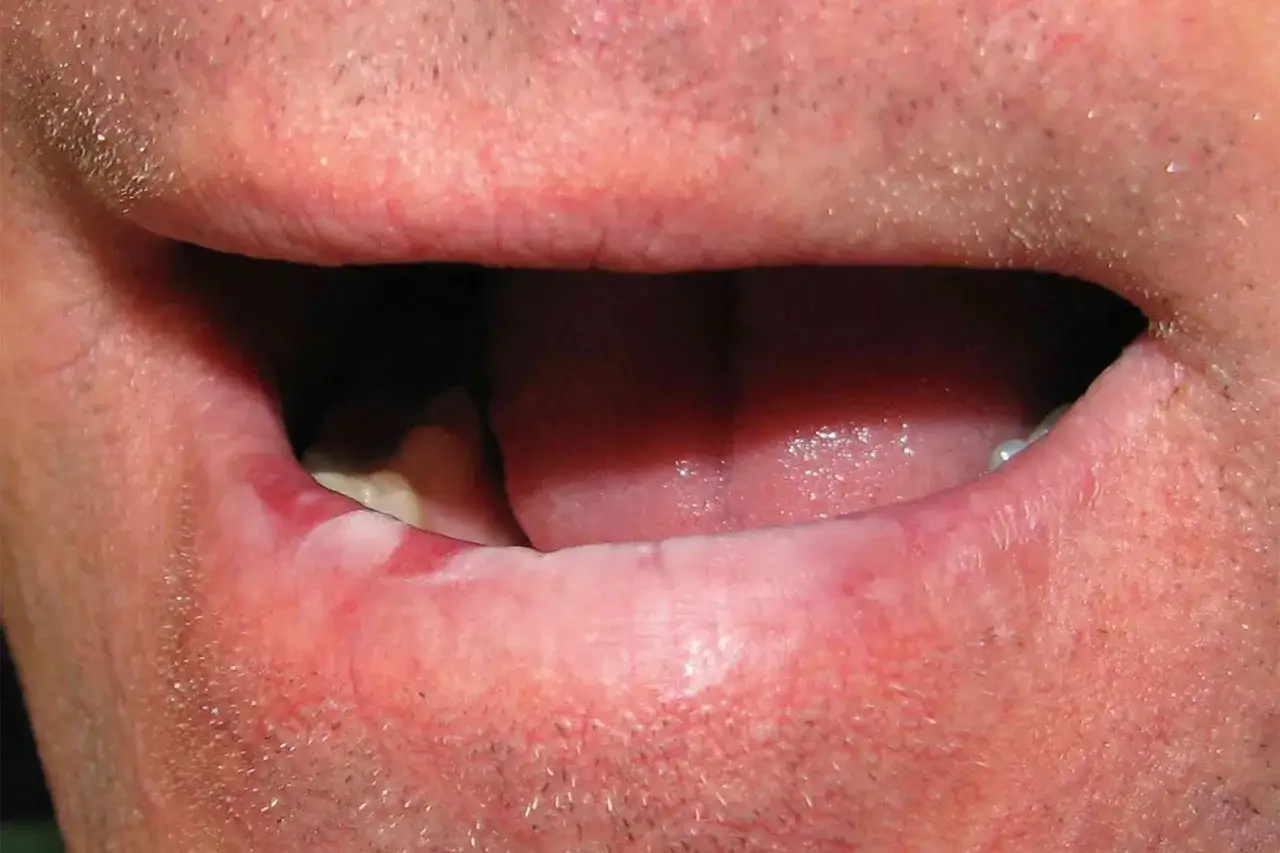 Una macchia bianca sul labbro inferiore, forse un segno di secchezza o irritazione, visibile vicino all'interno della bocca.