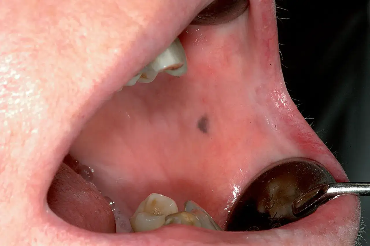 Piccolo neo scuro, una lesione pigmentata, sulla mucosa interna della guancia, vicino ai denti.