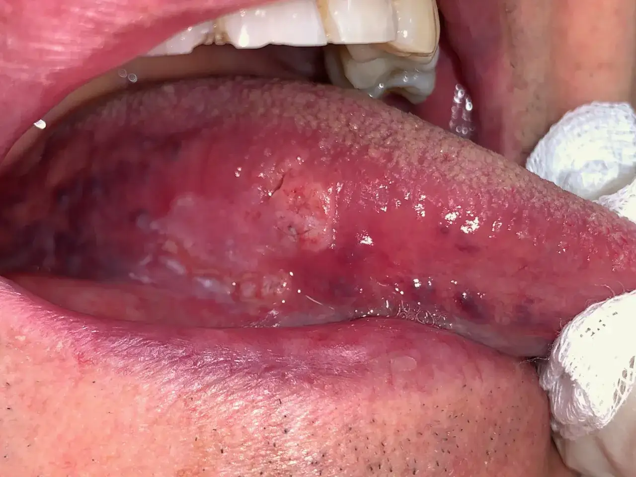 Lesione sulla lingua, in attesa di biopsia escissionale.