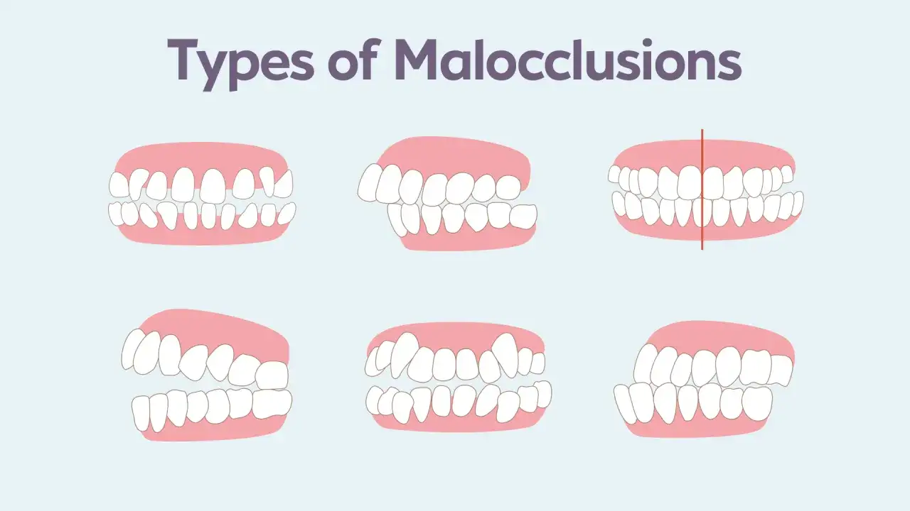 Illustrazione di diverse tipologie di malocclusione dentale negli adulti, mostrando denti disallineati e morsi errati.
