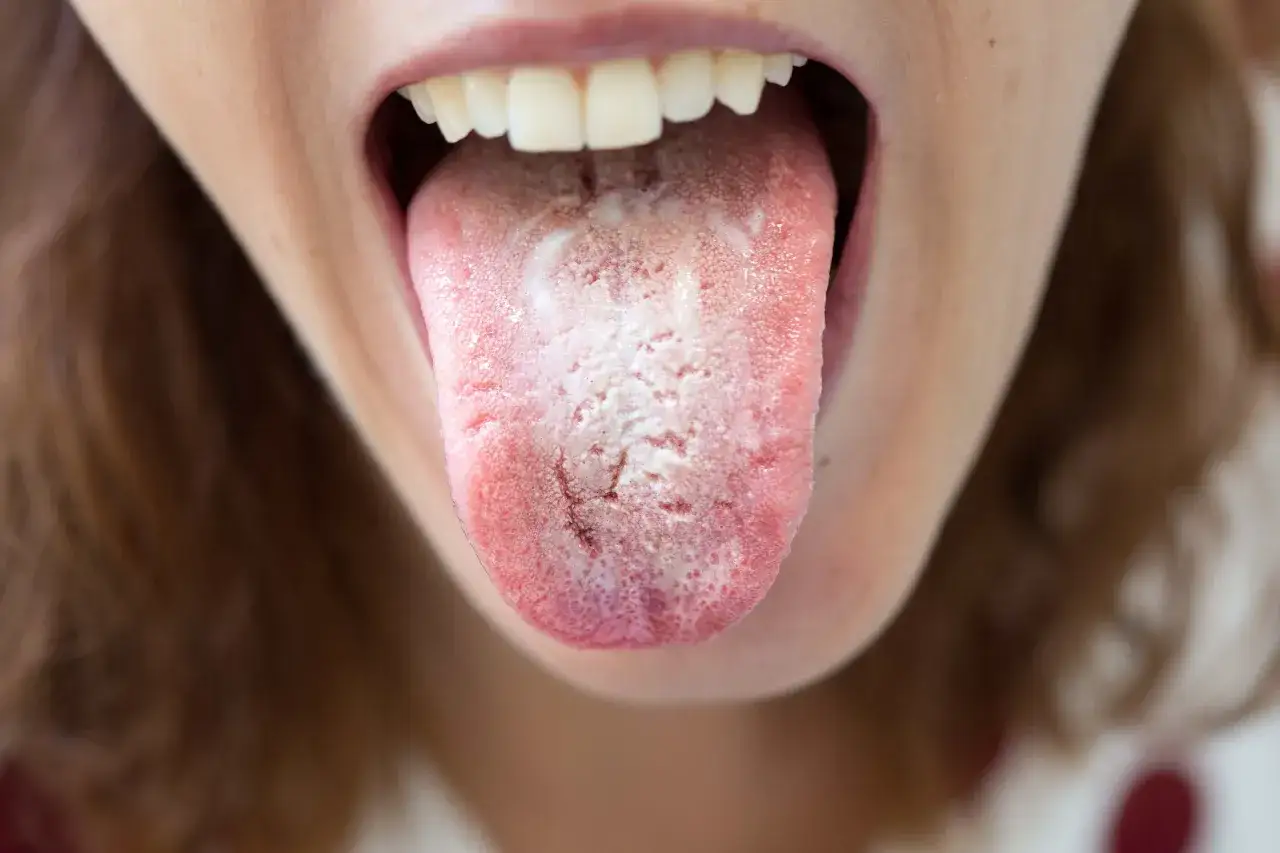 Lingua bianca e ruvida, con macchie rosse, dopo cura antibiotica. Potrebbe essere una lingua strana.