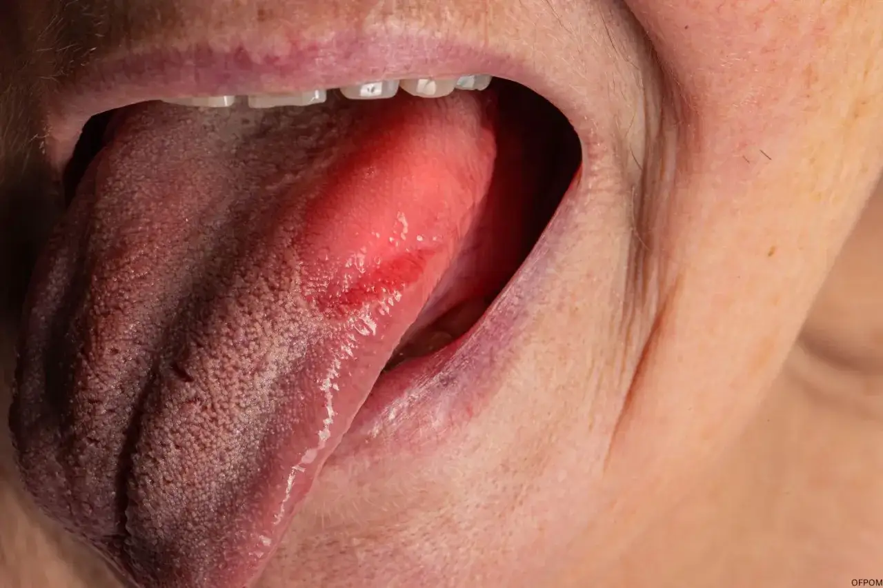 Lingua arrossata e irritata, segno di miglioramento per persone guarite dalla sindrome bocca urente.