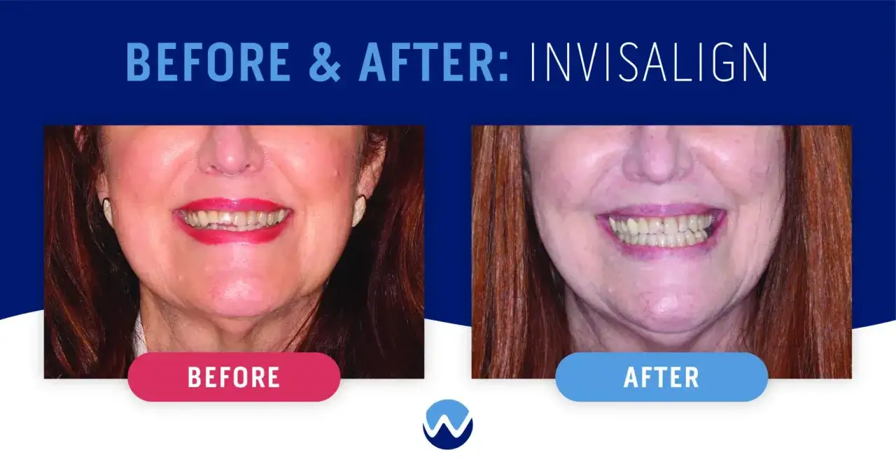 Confronto mascherine denti prima e dopo Invisalign: sorriso più allineato e luminoso.